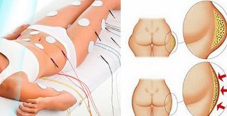 bienfaits des myostimulants